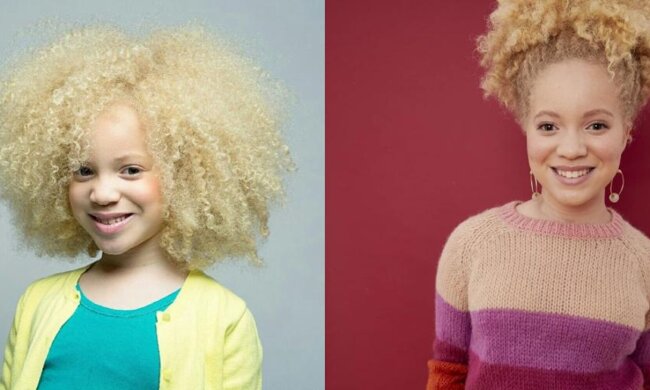 Afrykańska dziewczyna albinos zmieniła swoją osobliwość w godność